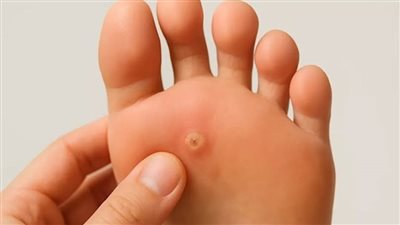 علاج مسمار القدم من البيت- 10 طرق طبيعية تخلصك من الكالو