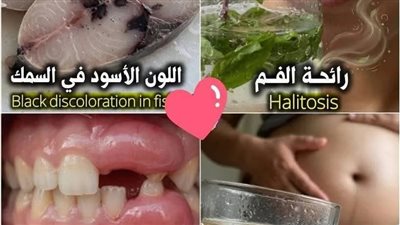 رائحة الفم: الغرغرة بالماء والملح أو مضغ القرنفل