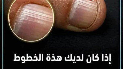 ماذا تعني الخطوط على الأظافر وأسباب ظهورها؟