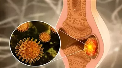 لا تتجاهلها- 5 أعراض تكشف إصابتك بأورام العظام