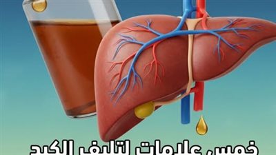 5 علامات خطېرة تشير لاقتراب الإصابة بتليف الكبد، لا تتجاهلها!